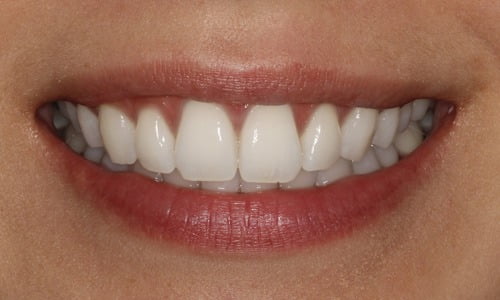 , Tooth Whitening