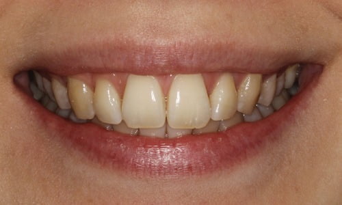 , Tooth Whitening
